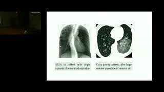 Lipoid Pneumonia An Uncommon Cause Of Pneumonia Dr Pratima Internal Medicine PGIMER [upl. by Belshin]