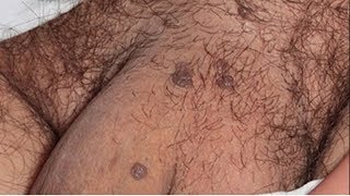 HPV em homens Conheça os sintomas causas prevenção tratamento [upl. by Leirud445]