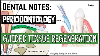 GUIDED TISSUE REGENERATION II PERIODONTAL SURGERY II PERIODONTOLOGY [upl. by Amiaj619]