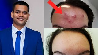 Get Rid Of Forehead Acne Naturally in just 7 days  Forehead Acne [upl. by Zosima]