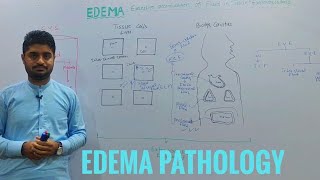 EdemaOedemaEdema pathologyintroduction to edema [upl. by Allene]