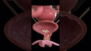 Bladder stones form when minerals in urine crystallize in the bladdershorts [upl. by Kelsi]