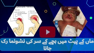 Encephaly kya hota haianencephaly in hindianencephaly baby 👶 [upl. by Shatzer]