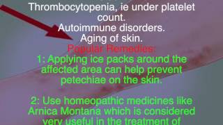 What are petechiae Remedies for petechiae [upl. by Anitniuq]