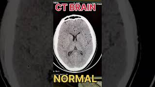 CT BRAIN NORMAL [upl. by Ettenad]