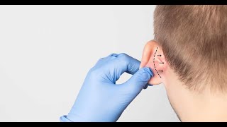 Otoplasty Recovery Day by Day  Ear Surgery Recovery  Lyfboat [upl. by Laflam]