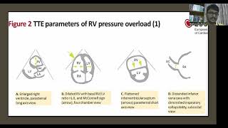 ESC Guidelines on Pulmonary Embolism 2019 By Dr Madhura de Alwis MD [upl. by Ayit]