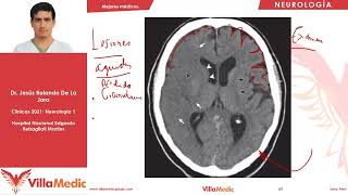 Enfermedad cerebrovascular parte 1  Villamedic Clínicas [upl. by Enilauqcaj]