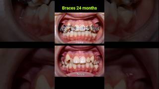 Braces correct all cases of crooked teeth braces orthodontist bracket [upl. by Ahsemik]