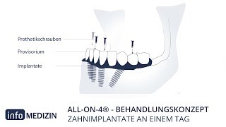 Allon4® Zahnimplantate an einem Tag  Einfach erklärt  info Medizin [upl. by Farron599]