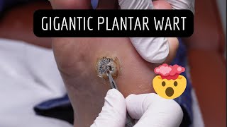 GIGANTIC Wart Removal Verruca Needling [upl. by Procter]