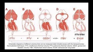 Transpulmonary Thermodilution method Case studies [upl. by Orgell]