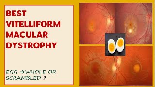 BEST VITELLIFORM MACULAR DYSTROPHY  pathophysiology  Symptoms stages investigations [upl. by Sells]