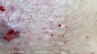 Big Cystic Acne Blackheads Extraction Blackheads amp Milia Whiteheads Removal Pimple Popping [upl. by Madelyn601]