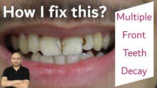 Front Teeth Refilling  How Dentist Remove Tooth Decay  Front tooth caries repair [upl. by Esten390]