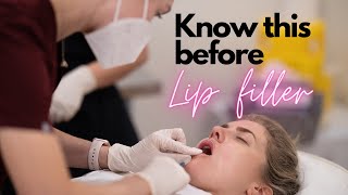 5 things to know before getting lip filler [upl. by Wylde479]