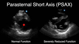 POCUS  Visually Estimating Cardiac Function [upl. by Decima]