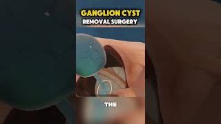 Ganglion Cyst Removal Surgery shortvideo [upl. by Datha703]