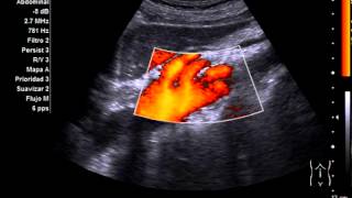 Aneurisma de aorta abdominal [upl. by Gerrie]