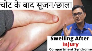 Swelling After Injury  चोट के बाद सूजनछाला   चोट की सूजन  COMPARTMENT SYNDROME [upl. by Fritts]