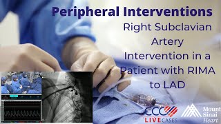 Right Subclavian Artery Intervention in a Patient with RIMA to LAD [upl. by Akehsat]