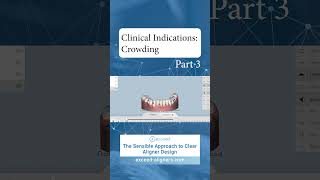 Clinical Indications Crowding Part 3 [upl. by Corsetti]