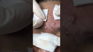 Inflamed Acne and Blackhead Removal CloseUp [upl. by Keram]