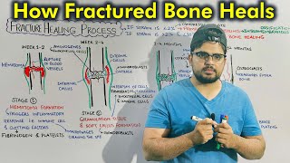 Fracture Healing Process Repair of Fractured Bone [upl. by Atteuqaj]