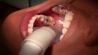 Minimally Invasive Cavity Treatment [upl. by Eimmit458]