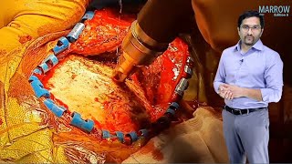 E6 Sample Video Epidural amp Subdural Hematoma Surgery [upl. by Yesiad]