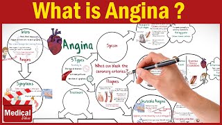 Pharmacology CVS 16 What is Angina Pectoris  Types of Angina Symptoms Causes and Treatment [upl. by Farlee]