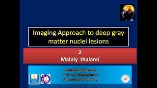 thalamic lesions [upl. by Repotsirhc]