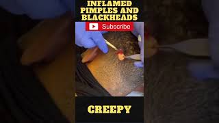 Giant Pimple Explosion Cyst Popping  Acne Pus Blackheads Bursting  ASMR Satisfying 13 😱😱 [upl. by Trant775]