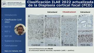 8 Neuropatología de las Displasias corticales Dr Jesús Cienfuegos Meza [upl. by Anrahs]