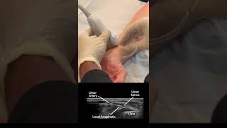 Ultrasound Guided Ulnar Nerve Block at The Wrist [upl. by Najib989]