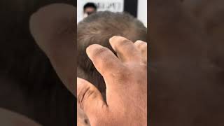 Scalp Micro Pigmentation in Sri Lanka [upl. by Atinele19]