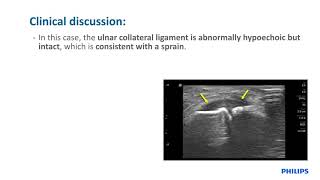 Philips Lumify case study Gamekeeper’s thumb by Jon Jacobson MD [upl. by Salema183]