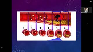 11 Cardiopatía Isquémica II Enf Coronaria Crónica [upl. by Rusell917]