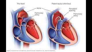 features of Patent ductus Arteriosus Failure of Ductus Arteriosus to close [upl. by Sidoney492]