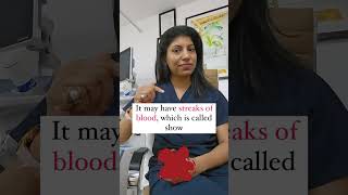 Vaginal discharge in pregnancy Doc Explains drbhumikabansal trending pregnancy discharge [upl. by Vitus]