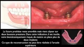 Prothèse amovible et implants dentairesMandibular overdentures [upl. by Arykahs]