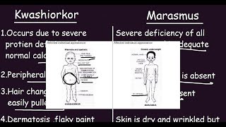 Kwashiorkor vs Marasmus Quick Differences amp Comparison [upl. by Weatherby869]