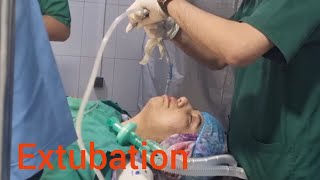 how to extubate patient after surgery Deep extubation [upl. by Selym]