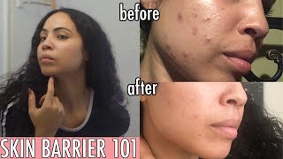 Repairing The Skin Barrier to Get Rid of Acne Before and After Results [upl. by Milinda397]