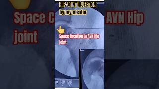 HIP JOINT INJECTION [upl. by Landon]