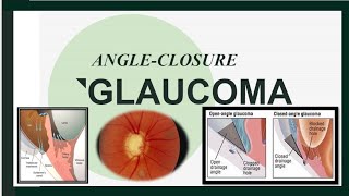 Closed Angle Glaucoma Acute amp Chronic [upl. by Bedad]