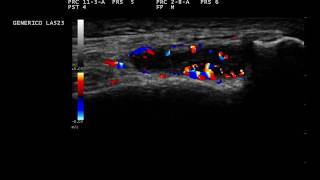 Knee Synovitis Ultrasound [upl. by Spaulding]