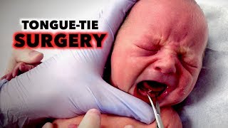 TONGUETIE SURGERY on NEWBORN Frenotomy  Dr Paul [upl. by Leirbaj478]