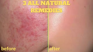 HOW TO GET RID OF ACNE  SCARS OVERNIGHT  3 DIY HOME REMEDIES  ALL NATURAL FACE MASKS 100 Works [upl. by Rosene664]