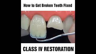 How to fix a chipped cracked or broken tooth MyDentCart  Cracked tooth repair  Broken Tooth [upl. by Stanzel]